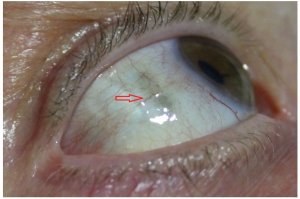 Oeil