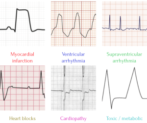 ECG
